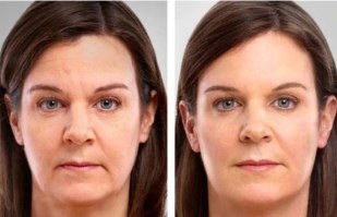 מכשיר מתיחת פנים וצוואר בטכנולוגיית מיקרו זרם