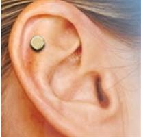 אלקטרודות זהב להפסקת עישון