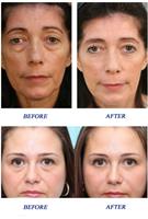 סרום טיפולי לעיניים- therapEYEserum