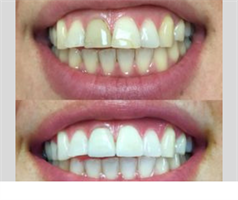 Whiter - מלבין השיניים האולטימטיבי