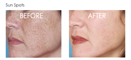 שמן ויטמין C מרוכז מאוד להלבנת העור