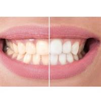 המשחה הסינית להלבנת השיינים