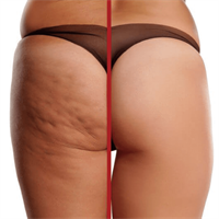 מדבקות מתיחה לעור- אפקט מיידי