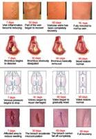 משחה טבעית להעלמת ורידים - ZB