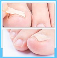 ​מדבקות ריפוי לציפורן חודרנית- HealignailS.K