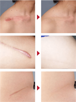 רצועת ג'ל אורגנית להעלמת צלקות -  Kinsmirat gel