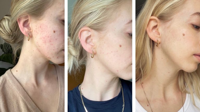 חוות דעת - Anti Acne - משחה לטיפול באקנה
