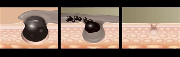 סרום לילה מובחר להורדת שחורים בפנים - סקיור