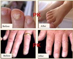 המשחה הסינית לפטרת הציפורן - Herbal