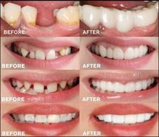 כיסוי שיניים קוסמטי להתאמה אישית - Fit Flex