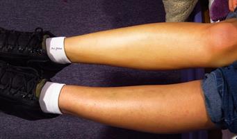 סבון לפיגמנטציה הבהרת העור