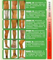 משחה סינית טבעית להעלמת ורידים - ZB