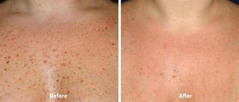 שמן ויטמין C מרוכז מאוד להלבנת העור