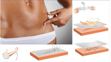 רצועת ג'ל אורגנית להעלמת צלקות -  Kinsmirat gel