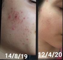 אזלייט Azelight  ביופור / אזוקייר Azo Care ביופור