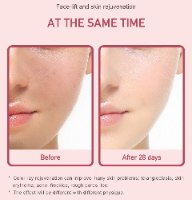 מזותרפיה להרמת הצוואר והסנטר- Technotherapy