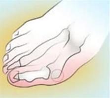 סד מיישר לטיפול בעצם בולטת