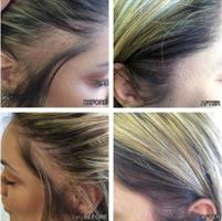 רולר משולש לצמיחת שיער אינטנסיבית בקרקפת