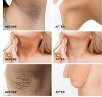 קרם להבהרת העור וטיפול בכתמי פיגמנטציה