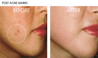 שמן ויטמין C מרוכז מאוד להלבנת העור