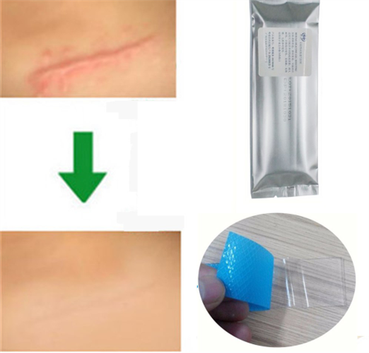 סיליקון ג'ל לטיפול בצלקות