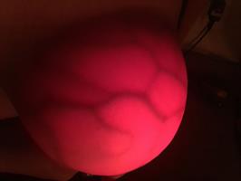 גלאי סרטן השד - אינפרא אדום