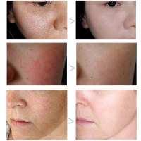 סרום פני חרסינה