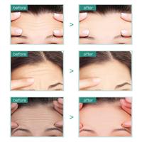 מסיכת אלוורה להחלקת קמטים במצח -מארז 2 יחידות