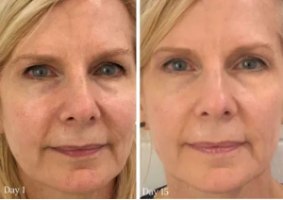 מכשיר מתיחת פנים וצוואר בטכנולוגיית מיקרו זרם