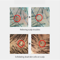 מברשת שיער למניעה וטיפול בקשקשים