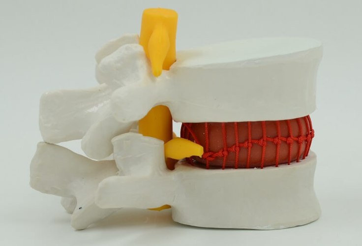 בהזמנה מראש: דגם אנטומי 138 - חוליות תחתונות עם הדגמת פריצת דיסק