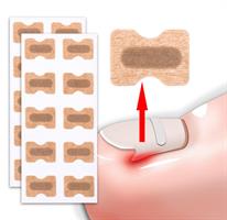 ​מדבקות ריפוי לציפורן חודרנית- HealignailS.K