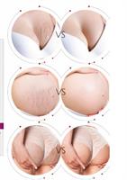 צלוליטיס - קרם לסימני מתיחה וצלוליטיס