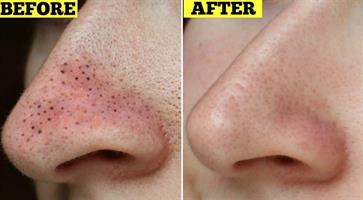 סרום לילה מובחר להורדת שחורים בפנים - סקיור