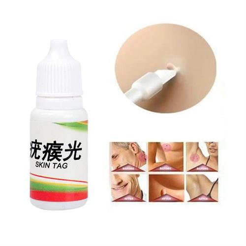תכשיר  להסרת שומות  - SKIN TAG