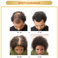 ספריי טיפולי לצמיחת שיער והפסקת נשירה