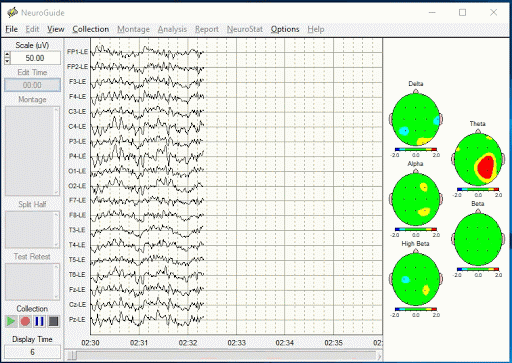 הדמיית-בדיקת-QEEG-אבחון-EEG-גלי-מוח-מכון-EEG